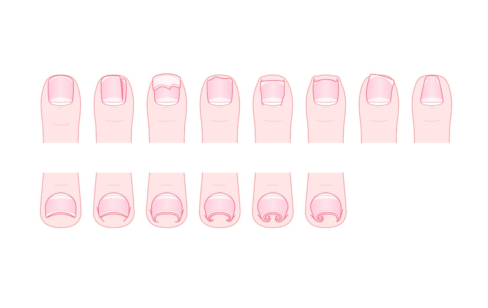 ingrown-nail
