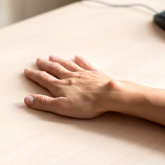 Wrist-ganglion-cyst