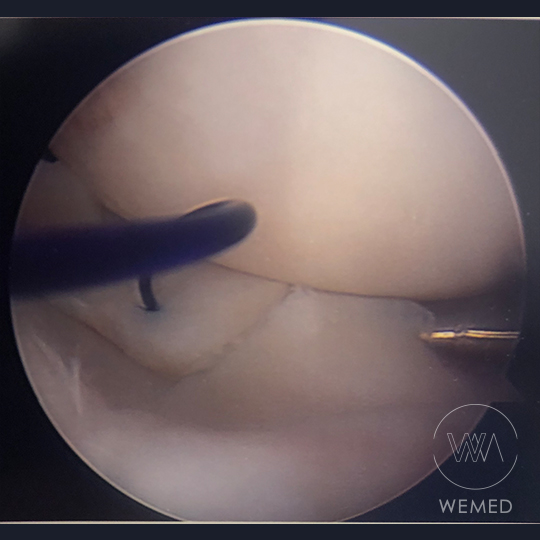 meniscus-knee